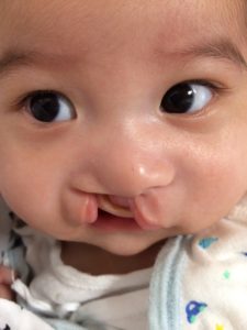 口唇裂だった時の顔