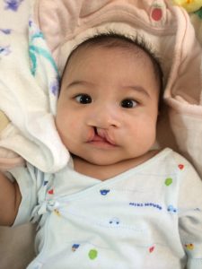 口唇裂だった時の顔