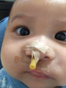 右の鼻のチューブは1ヶ月くらい入れておきます。