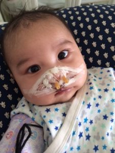 口唇裂のオペ②